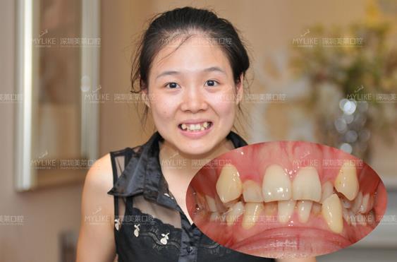 真人案例冰晶矫正