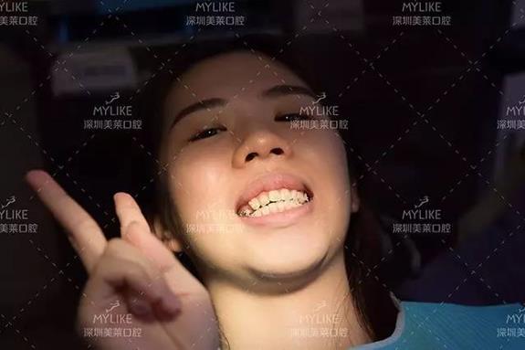 美女矫正牙齿