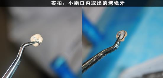 种植牙真人案例